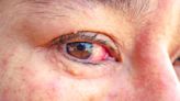 眼睛乾澀、眼壓高，小心肝腎出問題，補充4種護眼營養