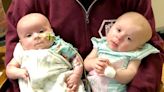 La angustia de una madre cuyas gemelas fueron diagnosticadas con cáncer de ojo