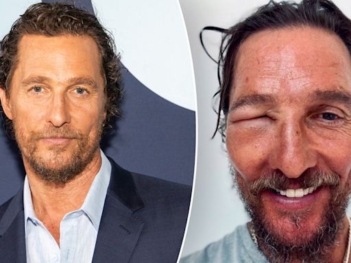 Matthew McConaughey shares shocking image of swollen eye: 'Bee swell'