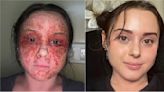 Woman says this small diet change helped to 'treat' her extreme eczema