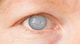 白內障手術一併處理近視、老花、散光，全焦段散光矯正人工水晶體，眼科醫師解說