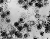 Herpes simplex virus