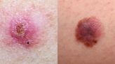 These Photos of Different Types of Skin Cancer Already Saved 1 Reader