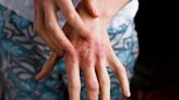 Recent drug approvals for atopic dermatitis boost treatment management