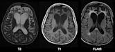 Frontotemporal dementia