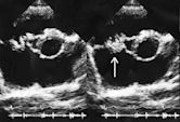 Subacute bacterial endocarditis