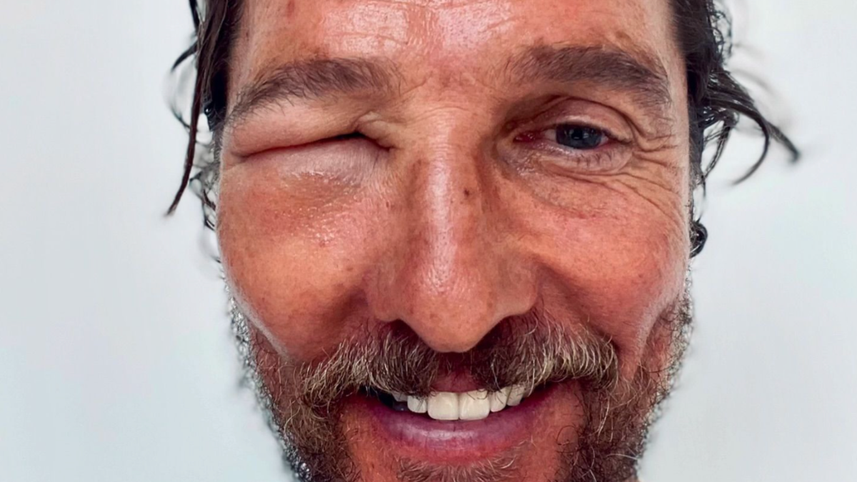 Matthew McConaughey Shares Photo of Bee Sting That Made His Eye Swell Shut