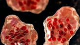 Measles outbreak in American Samoa declared public health emergency