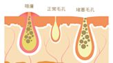 暗瘡 | 中西醫教你內外解決暗瘡問題：正確皮膚護理方法、食療、穴位、DIY去暗瘡印中藥面膜