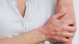 Psoriasis treatments can be life-changing