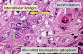 Squamous-cell carcinoma