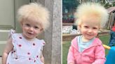 Toddler's 'awesome' hair diagnosed as 'uncombable hair syndrome'