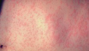 Health officials announce 1st confirmed measles case in Mass. resident since 2020