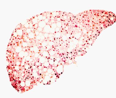 Diabetes and obesity can damage the liver to the point of failure – but few people know their risk of developing liver disease