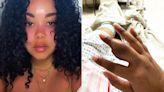 Woman's Finger Amputated After Shocking Discovery That Stiff Hand Was Actually Benign Tumor (Exclusive)