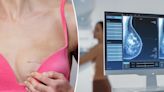 A double mastectomy to beat breast cancer will not improve chances of survival, study reveals