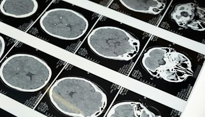 Alzheimer: estudo pioneiro da revista Nature é despublicado em ação rara; entenda