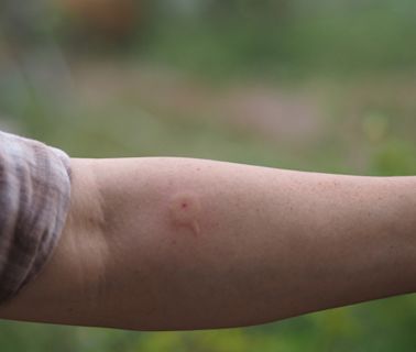 How to Treat a Wasp Sting