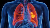 Johns Hopkins announces new blood test for early lung cancer detection