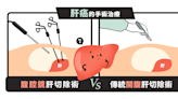 【李兆偉醫師】肝癌的手術治療：腹腔鏡肝切除術與傳統開腹肝切除術之比較