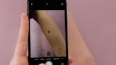 New AI software highly accurate for spotting melanomas, study shows