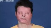 Homem passa por primeiro transplante de rosto e mostra resultado