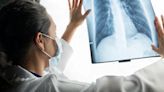 Cómo es el tratamiento para el cáncer de pulmón que prolonga la vida de los pacientes