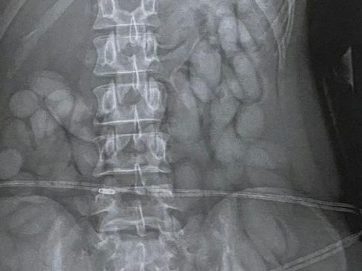 X-ray reveals 'cocaine bullets' found in stomach of woman stopped at airport