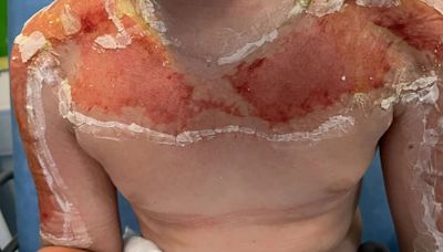 Horrific sunburn left my son, 10, needing surgery despite wearing SPF90