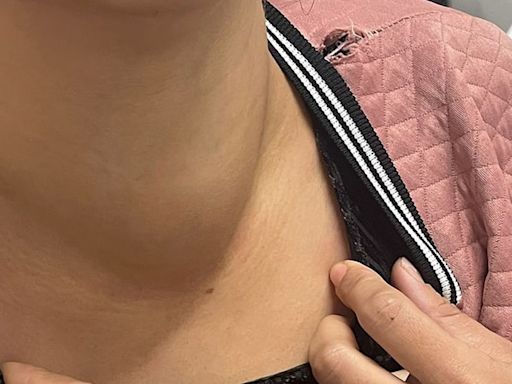 La Nación / Hospital de CDE: harán cirugía de bocio a 15 pacientes en semana de las tiroides