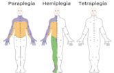 Tetraplegia