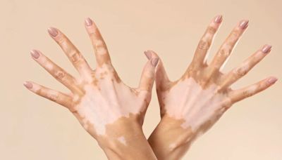 Día Mundial del Vitiligo: cuatro claves sobre esta condición que afecta la pigmentación de la piel