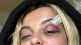 Bebe Rexha Shares Black Eye Pics After Phone Hits Her Face: 'I'm Good'