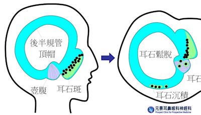 〈耳鳴暈眩保健專欄〉橢圓囊內膠品質不良 耳石一直掉一直暈