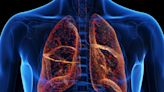 Lung-targeted CRISPR therapy offers hope for cystic fibrosis