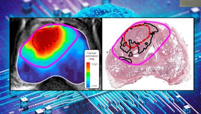 La Inteligencia Artificial supera a médicos en la detección del cáncer