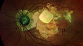 Bionic Eye Gets a New Lease of Life