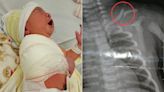 Bebê tem a clavícula fraturada durante o parto e família alega falta de assistência