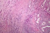 Anaplastic thyroid cancer