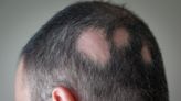 11 Ways to Get Rid of Bald Spots