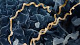 Doctors seeing more syphilis patients with unusual and severe symptoms, study shows