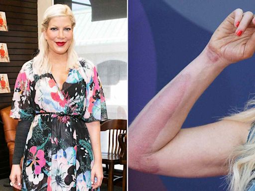 Tori Spelling Says She's 'Wearing My Thigh on My Arm' from Skin Graft After Falling on a Hot Hibachi Grill