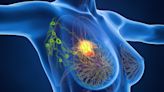 Gene Panel Predicts Early HER2+ Breast Cancer Prognosis