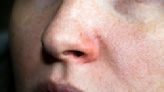 La alteración vascular en la nariz que se confunde con una enfermedad de la piel