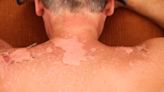Too Much Sun? Here’s How to Tell If You Have Sunburn or Sun Poisoning