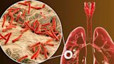 408 casos de tuberculosis con tratamiento médico