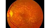 More evidence suggests regular consumption of melatonin can reduce chances of age-related macular degeneration