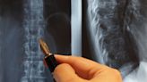 Canary Medical receives FDA breakthrough status for Lumbar Cartridge