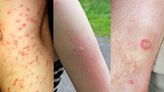 13 common bug bites and how to spot them