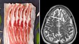 Worm Eggs Found in Man's Brain After He Complained of Migraines — and Undercooked Bacon Is to Blame